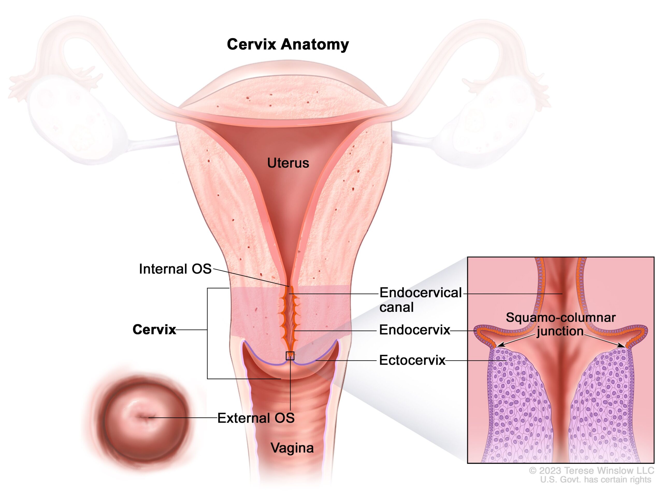 Cervical Cancer